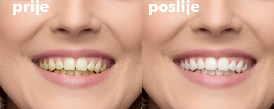 Je li izbjeljivanje dobro za zube?